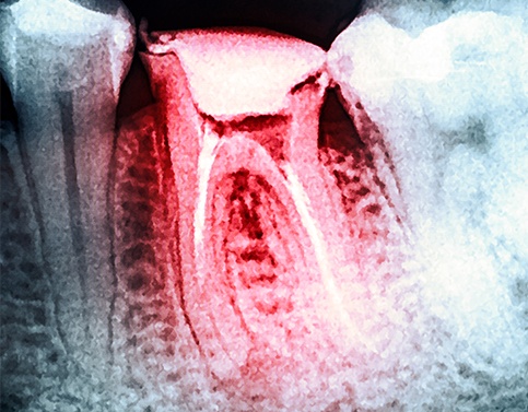 X-ray of damaged tooth prior to extraction