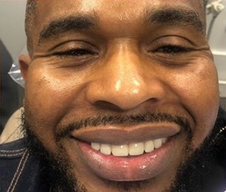 Man smiling after dental treatment