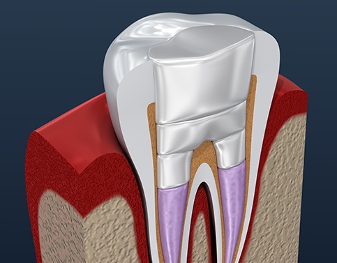 Aniamted tooth after root canal therapy