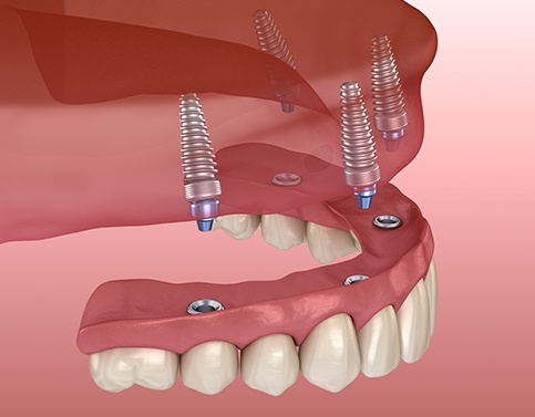 Animated all on 4 dental implant denture placement
