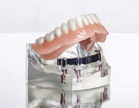 Model all on 4 dental implant denture