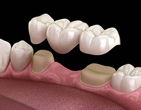 Illustration of dental bridge being placed on prepared teeth
