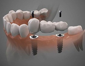 Illustration of dental implant bridge for lower arch
