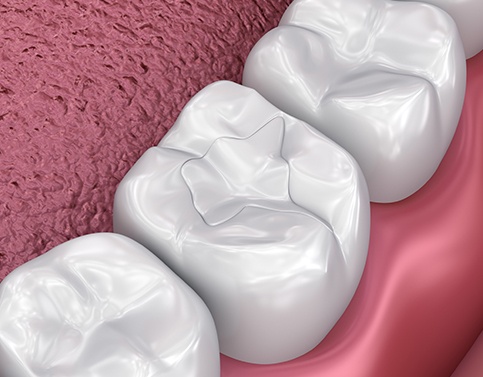 Animated tooth with dental filling