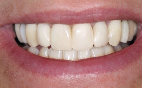 Brilliant white healthy smile after cosmetic dentistry