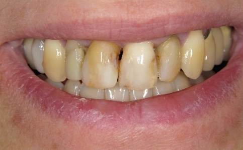Yellowed decayed teeth before cosmetic dentistry
