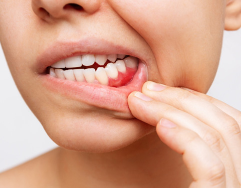 Patient showing red, inflammed gums