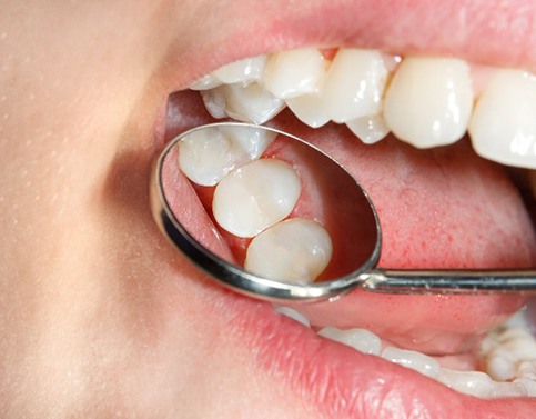 metal fillings vs tooth-colored fillings in Edison 