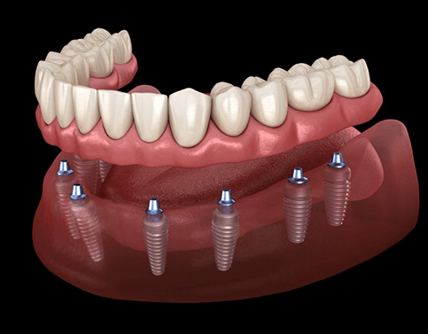 a 3D illustration of an implant denture in Edison