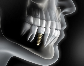 Diagram of an integrated dental implant in Edison