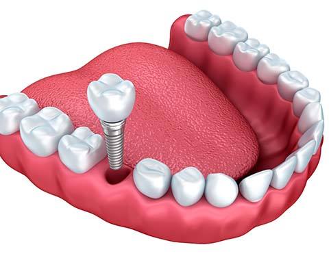 model of how dental implants in Edison work