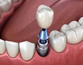 single dental implant supporting a crown