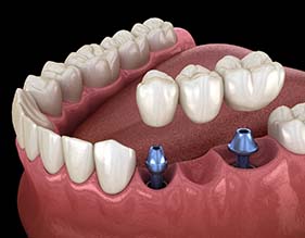 two dental implants supporting a bridge