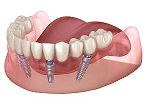 All-on-4 denture on four dental implants