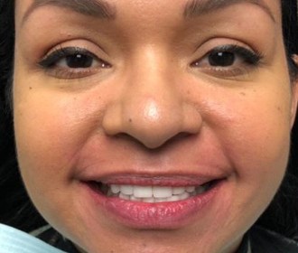 Woman smiling after dental treatment