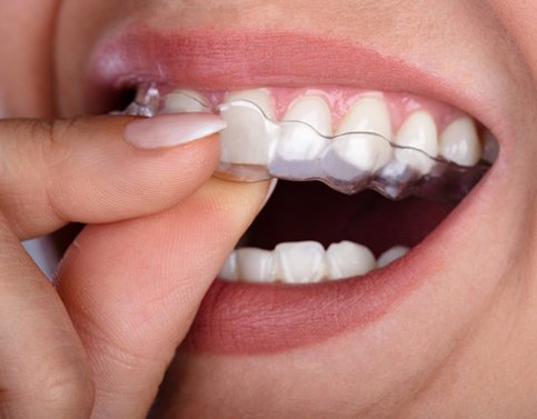 close up of person putting aligner in their mouth 