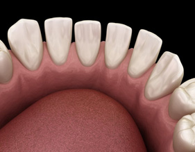 Illustration of teeth with gaps
