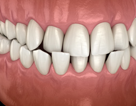 Illustration of teeth with crossbite