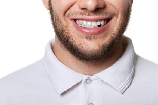 Replace missing teeth near Clark