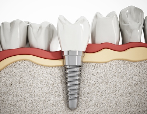 Animated dental implant supported dental crown