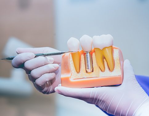 Dentist pointing to a dental implant model