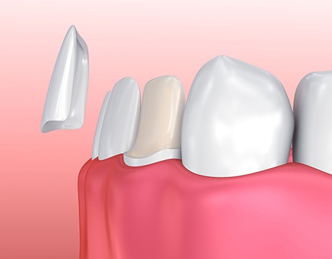 model of veneer being placed on bottom tooth 