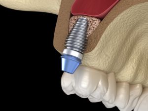 dental implant in Edison replacing upper tooth 