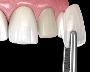Render of a temporary veneer being placed on the tooth