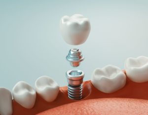 Illustration of a dental implant abutment and crown in a lower arch