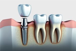 Illustration of dental implant abutment and crown