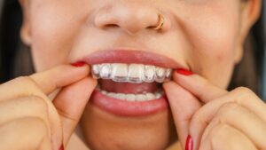 a woman putting Invisalign aligners in her mouth