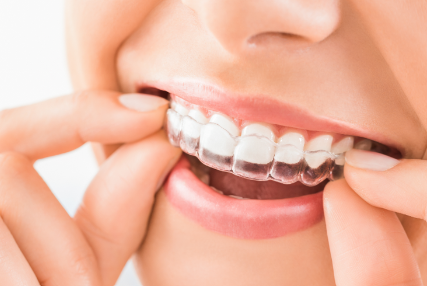 Woman trying on Invisalign