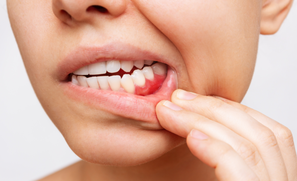 Close up of mouth showing irritated gums