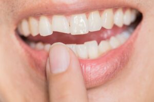 Person pointing to their broken tooth